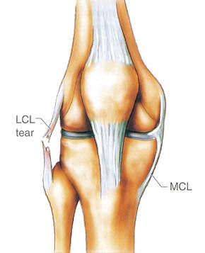 膝关节外侧副韧带损伤(转载)